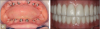 Fig 11. Screw-retained zirconia prostheses (maxillary and mandibular arches).