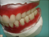 Fig 12. Wax-up in posterior crossbite.