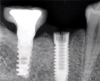 (2.) Fracture of the coronal portion of the trilobe connection of a standard diameter implant fabricated from CP-Ti grade 4 related to mechanical overloading.