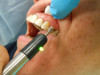 Fig 7. An electric pulp test (EPT) is used to test a treatment tooth before and after giving local anesthesia to confirm profound pulpal anesthesia.